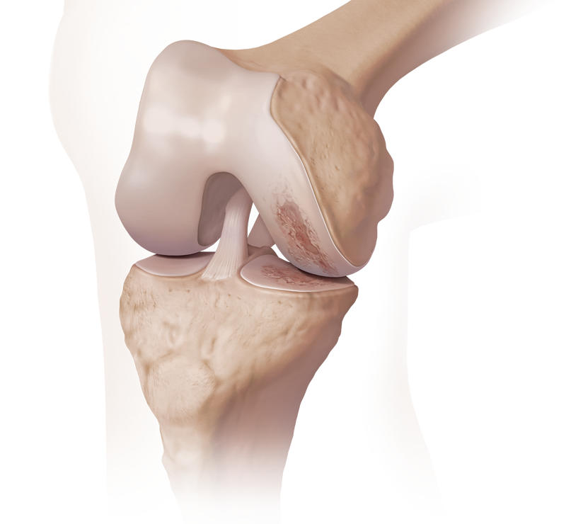 dam-media/knee_arthritis-1-taxonomy